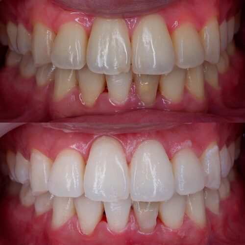 Bleaching 2