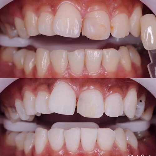 Bleaching 3