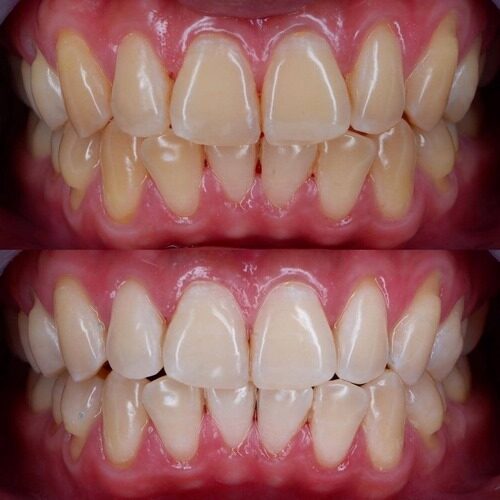 Bleaching 4