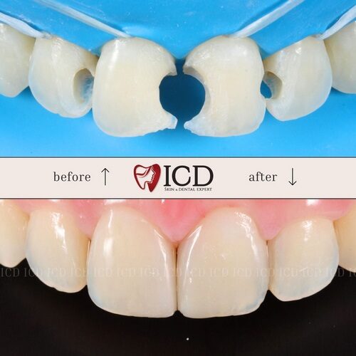 Restorative 2