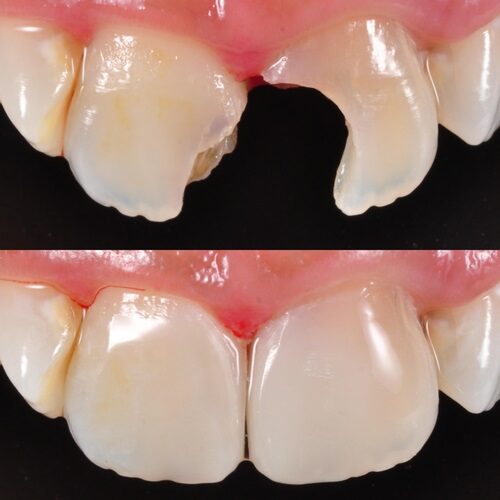 Restorative 3