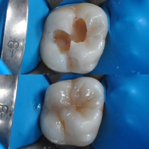Restorative 4