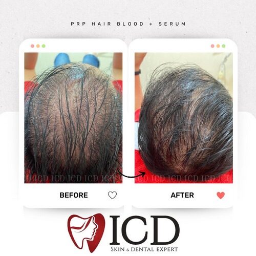 testimoni - ICD - 1