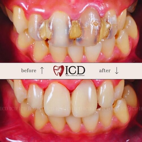 testimoni - ICD - 11