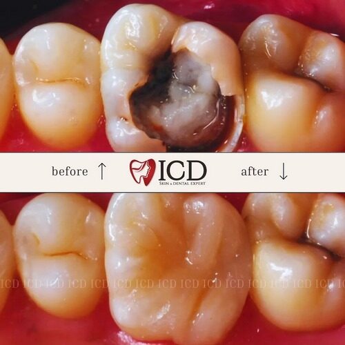 testimoni - ICD - 13