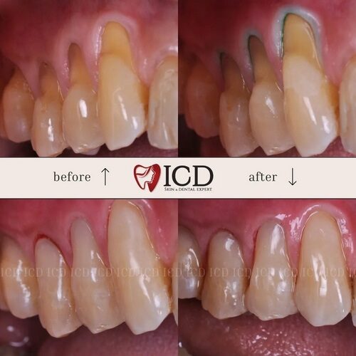 testimoni - ICD - 15