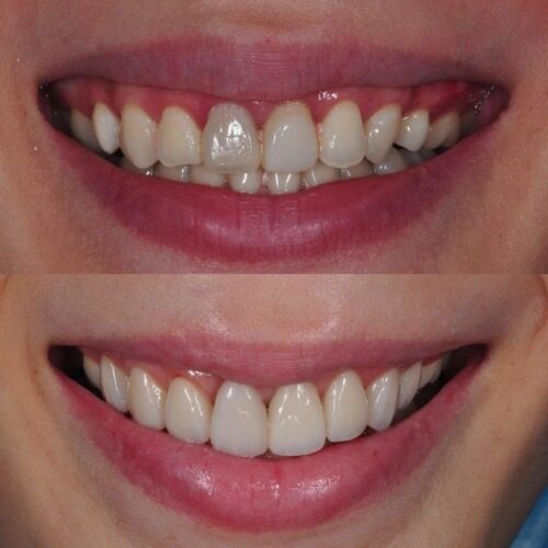 veneer gigi 1