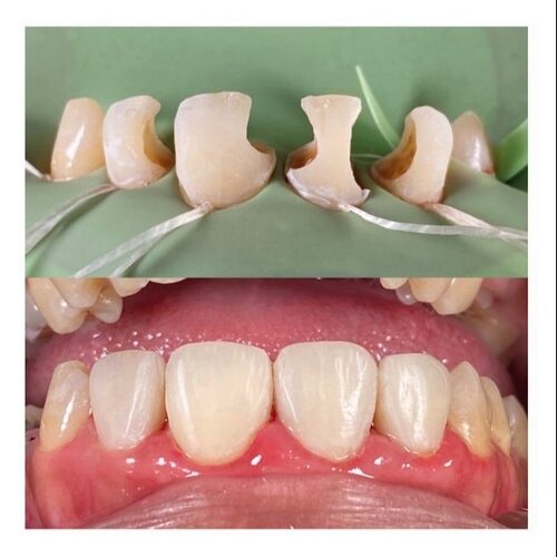 veneer gigi 2