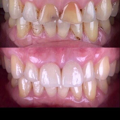 veneer gigi 3